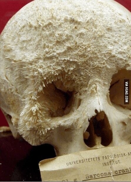 skull of a patient with aversion bone cancer.jpg