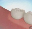 an operation to remove an ambulatory wisdom tooth