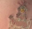 A video of a cute tattoo removal procedure, GIF.