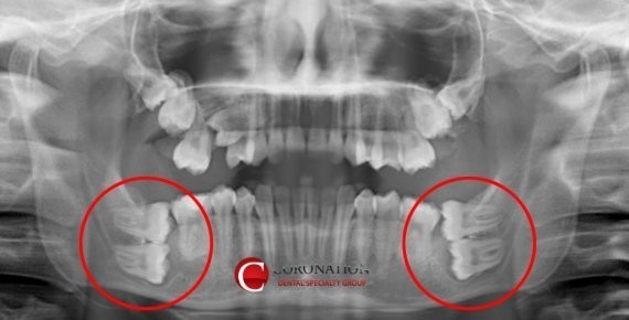Wisdom tooth location where you will experience hell when you remove it.jpg