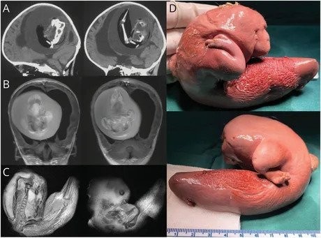 Twin growing in the brain of a hate 1-year-old girl