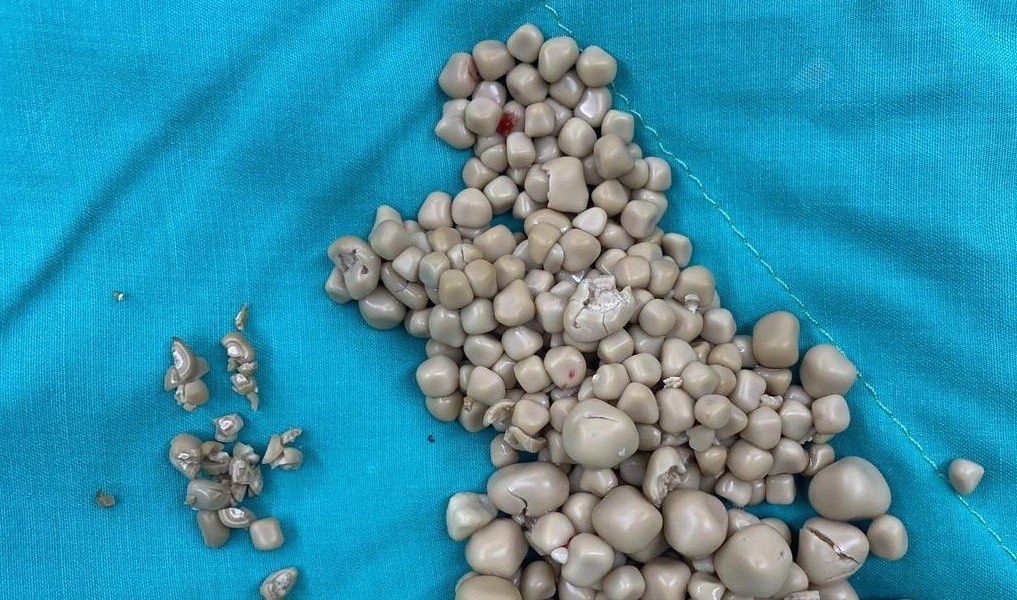 300 kidney stones removed by Taiwanese who refused to drink medicinal herbs.JPG