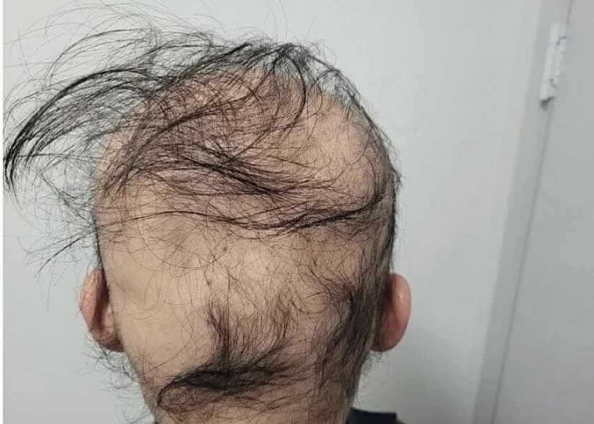 DC hair loss gallery case legend ㄷㄷ